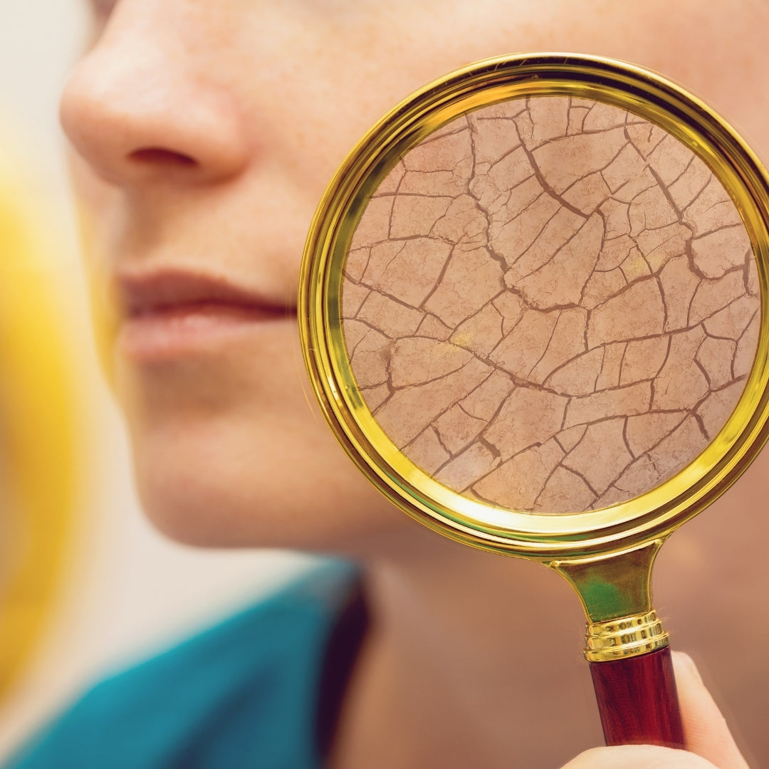 Dehydrated Skin