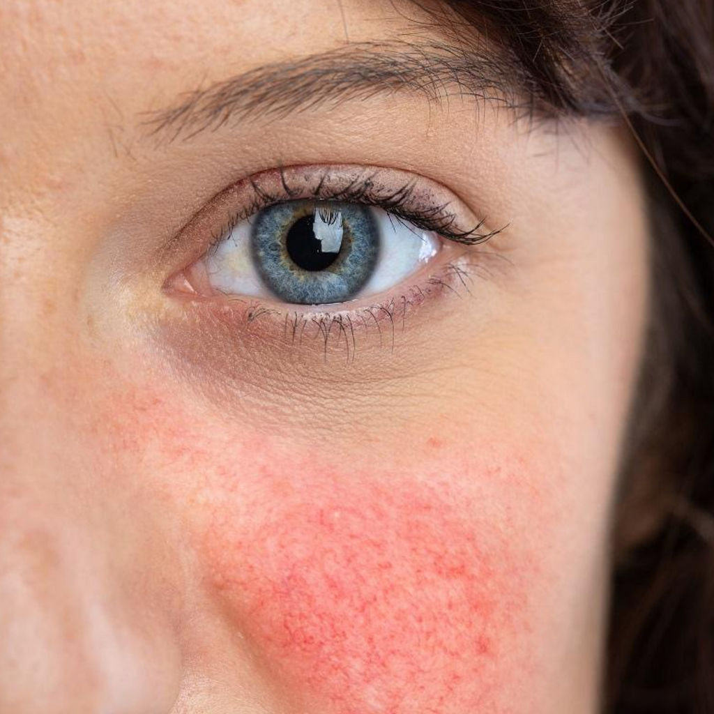How To Treat Rosacea: 6 Superb Skincare Tips